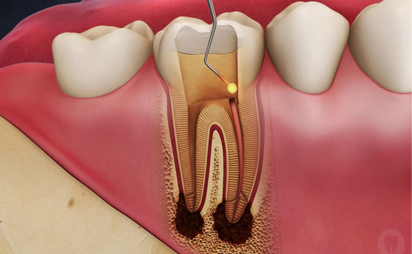 Kanal Tedaisi Endodonti